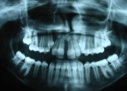 Ortodontia Com Máscara Facial