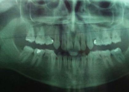  Ortodontia E Implantes