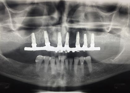 PROTOCOLO Acrílico Sobre Implantes