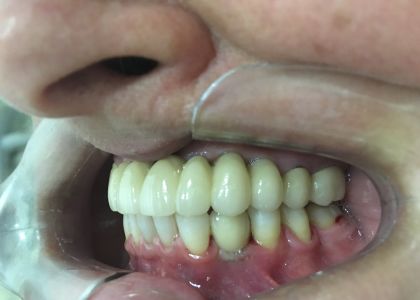 Reabilitação Oral Com Implantes.