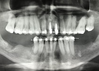 Ortodontia E Implantes 2