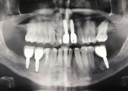 Ortodontia E Implantes 2