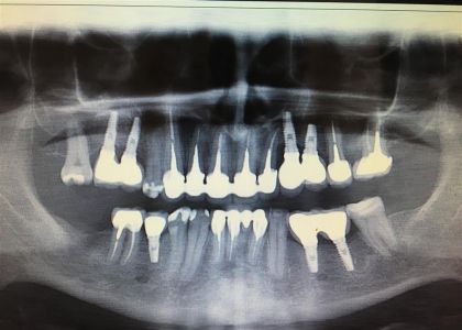 Reabilitação Oral Com Implantes