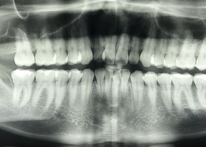 Ortodontia Com 3 Extrações.