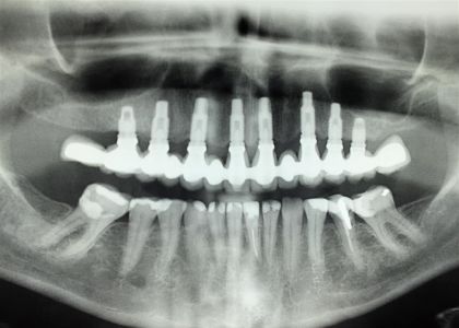 Protocolo Cerâmico Sobre Implantes 2