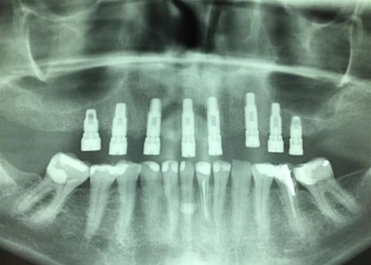 Protocolo Cerâmico Sobre Implantes 2