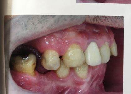 Reabilitação Oral Com Implantes