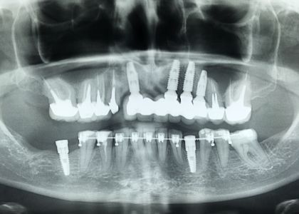 Reabilitação Oral Com Implantes.