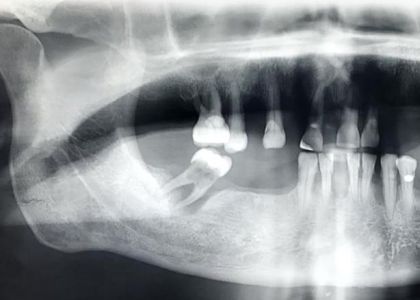 Protocolo Metalo-Plástico 5 Implantes Inferior