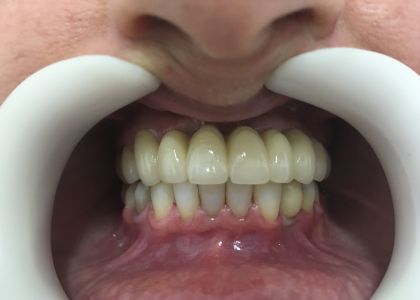 Reabilitação Oral Com Implantes.