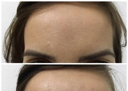 BOTOX(Toxina Botulínica)