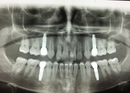  Ortodontia E Implantes