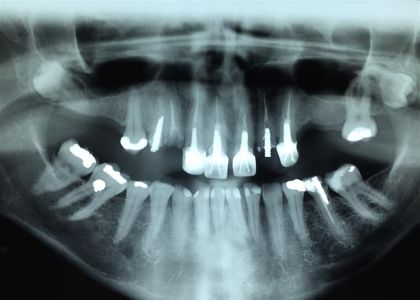 Protocolo Cerâmico Sobre Implantes 2