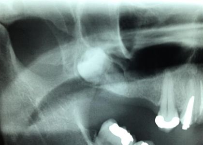 Protocolo Cerâmico Sobre Implantes 2