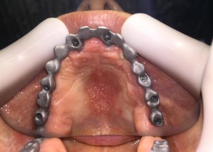 Protocolo Cerâmico Sobre Implantes