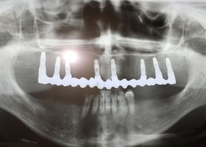 Protocolo Cerâmico Sobre Implantes