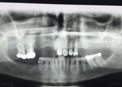 PROTOCOLO Acrílico Sobre Implantes