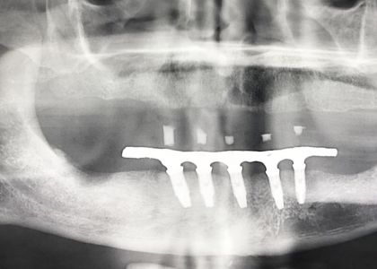 Protocolo Metalo-Plástico 5 Implantes Inferior