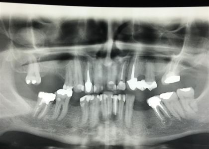 Reabilitação Oral Com Implantes