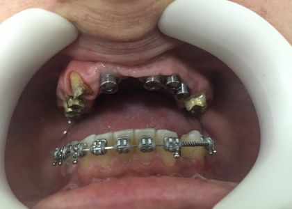 Reabilitação Oral Com Implantes.