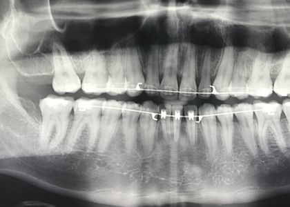 Ortodontia Com 3 Extrações.