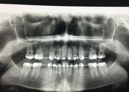  Ortodontia E Implantes