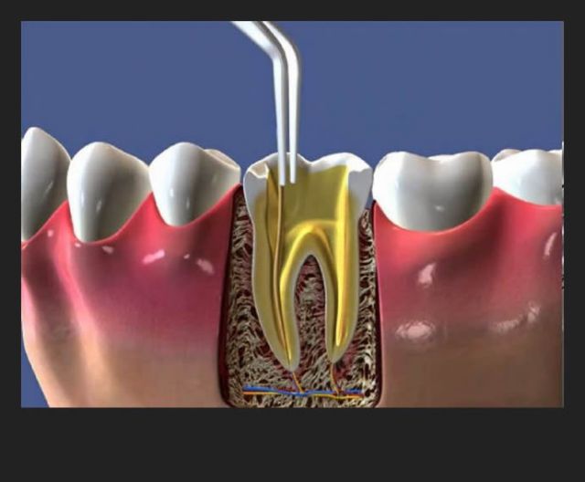 Tratamento de Canal (Endodontia)