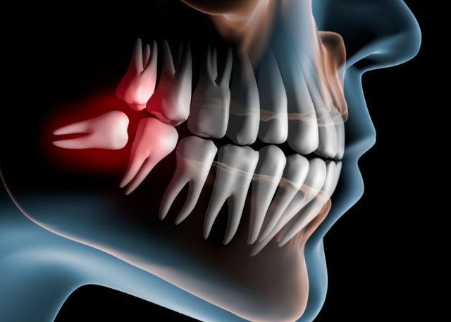 Cirurgia e Extração de Sisos