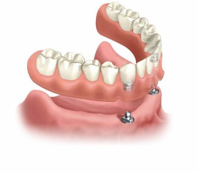 Prótese Total Implantada - Overdenture (Dentadura)