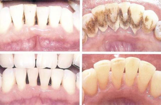 Tratamento Periodontal