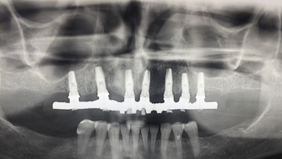 PROTOCOLO Acrílico Sobre Implantes