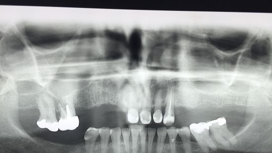 PROTOCOLO Acrílico Sobre Implantes